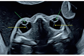 Dépistage des pathologies oculaires du fœtus : le temps du dépistage 2.0 Dépistage des pathologies oculaires du fœtus : le temps du dépistage 2.0
