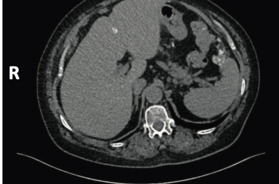 Cancers séreux de bas grade : implications chirurgicales