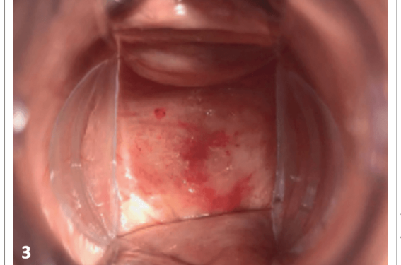 Sécheresse vaginale : estrogène, hydratant, lubrifiant ou laser Sécheresse vaginale : estrogène, hydratant, lubrifiant ou laser