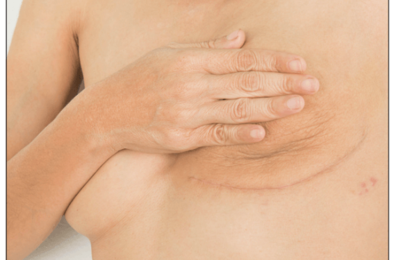 Cancers du sein RE+ Her2- | Des milliers de chimiothérapies inutiles : l’essai RxPONDER clôt la discussion Cancers du sein RE+ Her2- | Des milliers de chimiothérapies inutiles : l’essai RxPONDER clôt la discussion