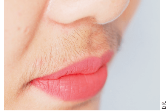 Hirsutisme sévère – Quelle prise en charge ? Hirsutisme sévère – Quelle prise en charge ?