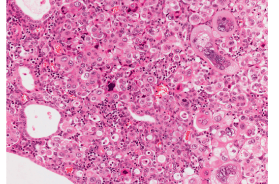 Cancer de l’endomètre – Que retenir des nouvelles recommandations ? Cancer de l’endomètre – Que retenir des nouvelles recommandations ?