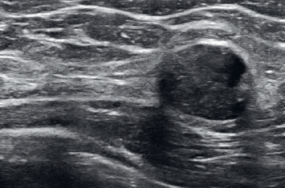 Suites de lipofilling