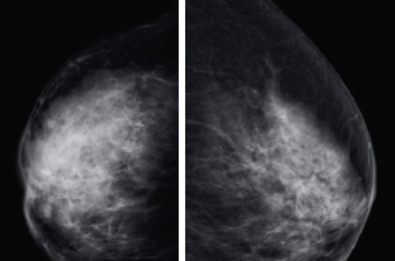 Lymphome primitif du sein Lymphome primitif du sein