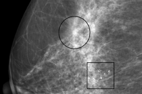 Deux foyers de microcalcifications - L’arbre qui cache la forêt